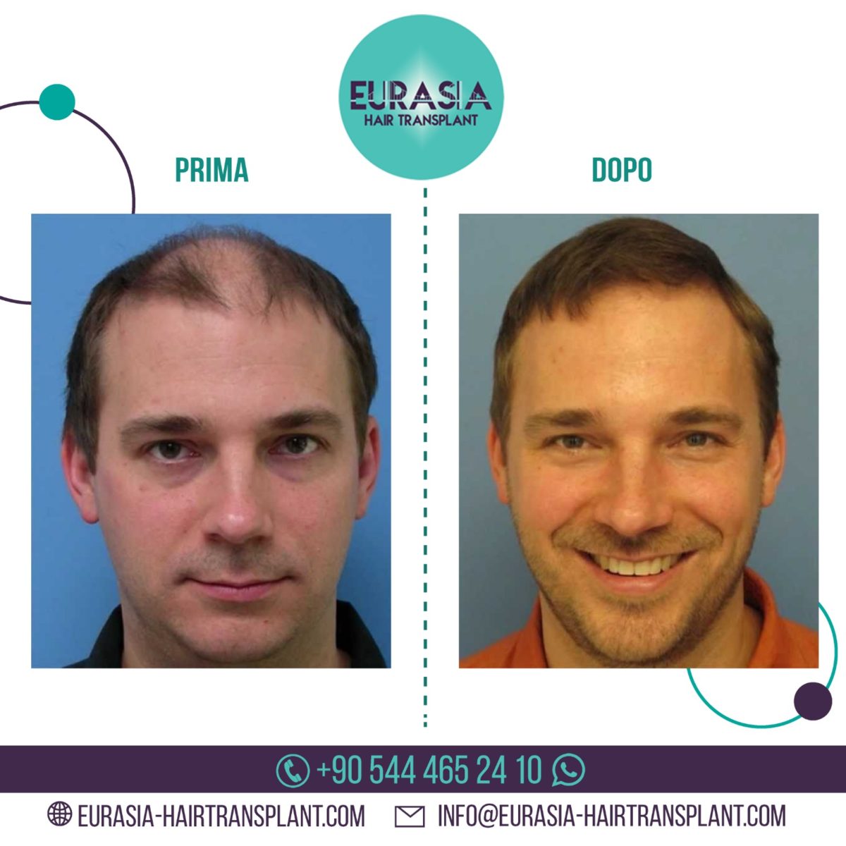 Videos and photos about hair transplant, before and after photos